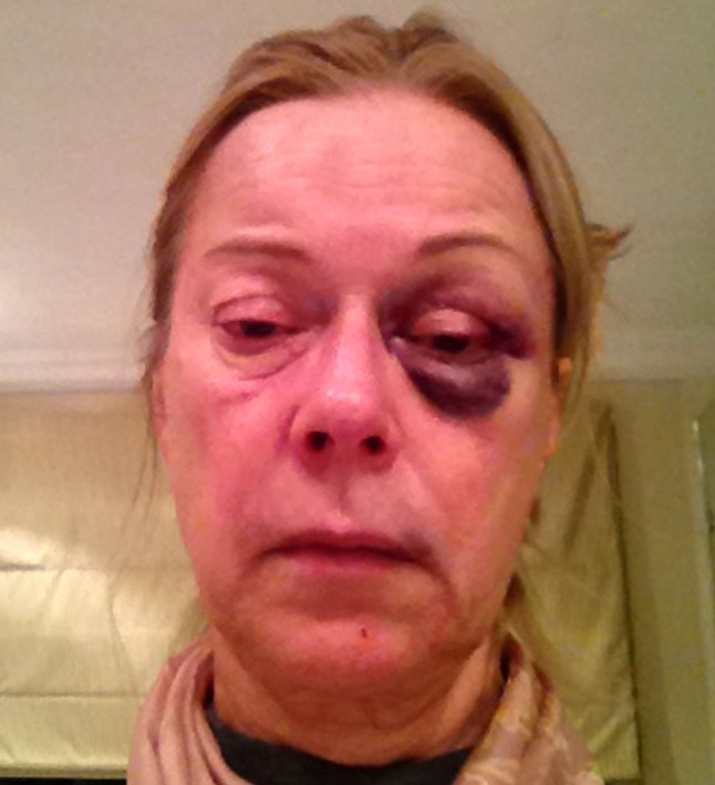 Undated handout photo issued by Surrey Police of the injuries sustained by Susan Morris after a raid by an armed burglar in October 2017 at her house in Surrey. PRESS ASSOCIATION Photo. Issue date: Tuesday January 30, 2018. Detectives say that the meticulous research and use of extreme violence by the lone raider suggest the thief, who raids homes while armed with a sawn-off shotgun, is currently or has previously served with the armed forces. See PA story POLICE Burglar. Photo credit should read: Surrey Police/PA Wire NOTE TO EDITORS: This handout photo may only be used in for editorial reporting purposes for the contemporaneous illustration of events, things or the people in the image or facts mentioned in the caption. Reuse of the picture may require further permission from the copyright holder.