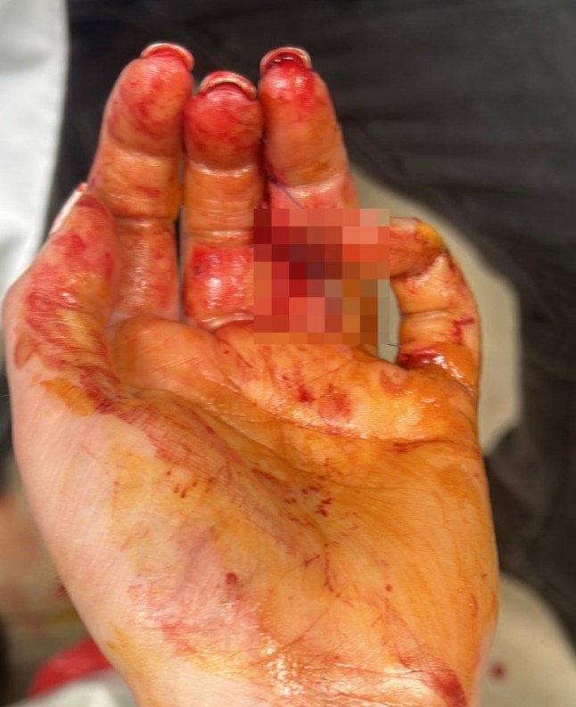 British woman mauled by shark reveals how she thought she was going to die