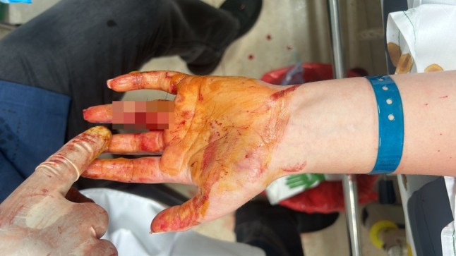 Rachel Smith's bloodied hand after a shark bite.