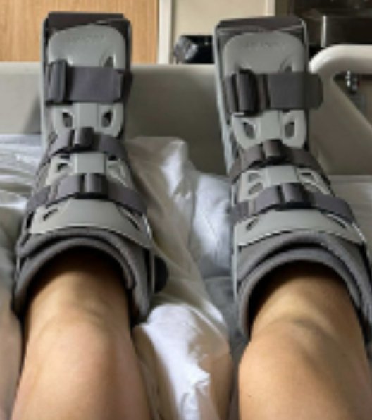 A young British woman suffered horrific injuries in a 30ft fall on her dream job working as a summer camp leader in the United States - and her family need ??45,000 to get her home. Charlotte Hollins Anderton, 23, plummeted 30ft during an accident on a hike while celebrating Independence Day in the summer camp with children. Her family say she had to wait eight-hour wait for rescue - with a fractured spine, two shattered feet and internal bleeding. Her family say her insurance cover to get her back to Britain has been turned down as they face the ??45k bill. WALES NEWS SERVICE
