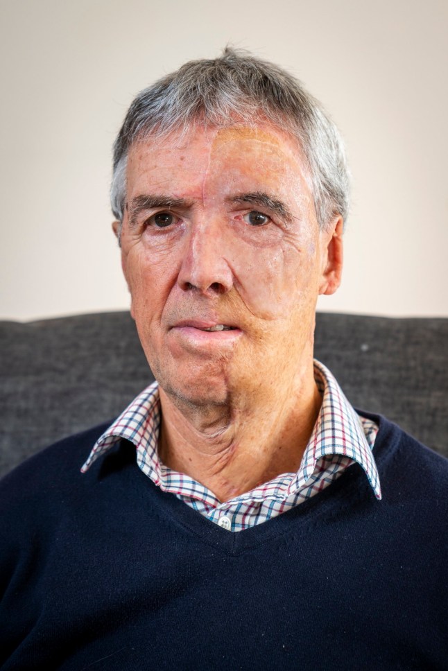 Dave Richards, at his home in Budliegh Salterton, Devon. As part of his treatment, Dave received a 3D prothesis that fits the space on his face and mimics his hair colour, eye colour and skin. // A cyclist injured by a drunk driver is the first to benefit from a unique NHS body parts printing centre - that built him a 3D face. Dave Richards, 75, was 'lucky to survive' the crash which damaged his back and pelvis and saw him break multiple ribs on one side of his body. He also received full thickness burns to the side of his face including his eye, nose and part of his neck. During his recovery, he was referred to Reconstructive Prosthetics, which has just opened The Bristol 3D Medical Centre. It is the first of its kind in the UK to have 3D scanning, design and printing of this kind in a single NHS location. The centre, based in Frenchay, Bristol, provides scientific and technical support to trauma patients through state-of-the-art digital technology and specialist reconstructive expertise. Dave, from Devon, was able to use the services at the centre after the accident. Photo released 27/10/2025