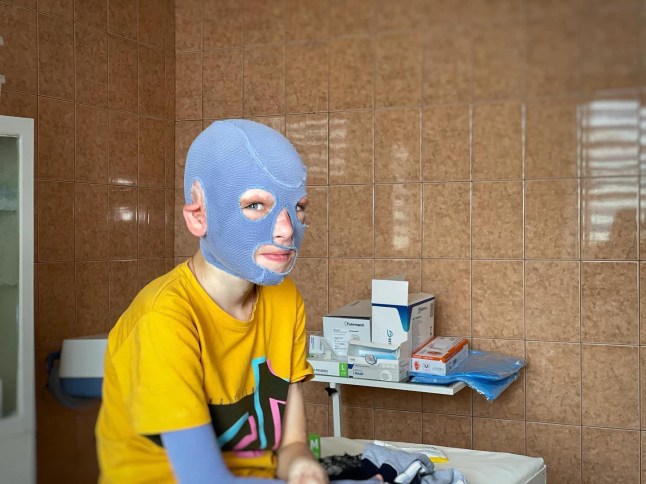 ukraine.ua 115w Roman Oleksiv, 8, undergoes rehabilitation after suffering 45% burns to his body in a Russian missile strike. The boy has to wear a special compression mask to minimise scarring and needs further scar treatment. On July 14, 2022, Russia hit the centre of Vinnytsia. The attack killed 28 people, including Roman?s mother, and injured more than 200. We thank Ukrainian and German doctors for saving the boy's life! Photos: First Lviv Medical Association
